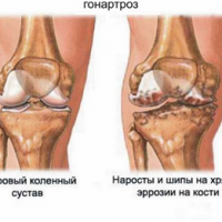 Почему при артрозе коленного сустава необходим компресс с имбирем на почки?